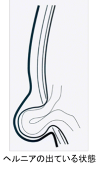 成人の鼠径ヘルニアについて