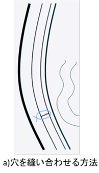 成人の鼠径ヘルニアについて