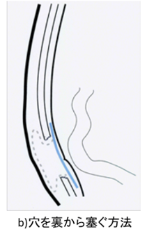 成人の鼠径ヘルニアについて