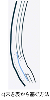 成人の鼠径ヘルニアについて