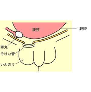 こどもの鼠径ヘルニアについて（図１）