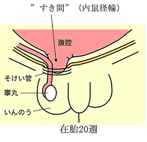 こどもの鼠径ヘルニアについて（図２）