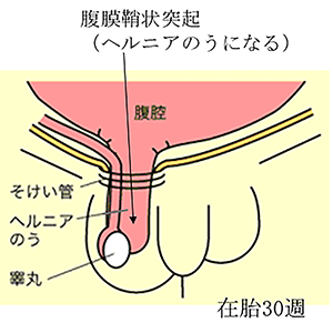 こどもの鼠径ヘルニアについて（図３）