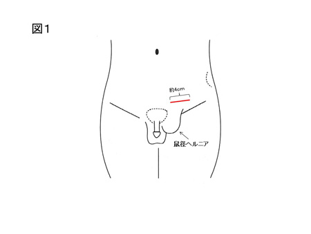 鼠径ヘルニア（成人）の手術方法について（図１）