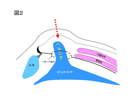 鼠径ヘルニア（成人）の手術方法について（図２）