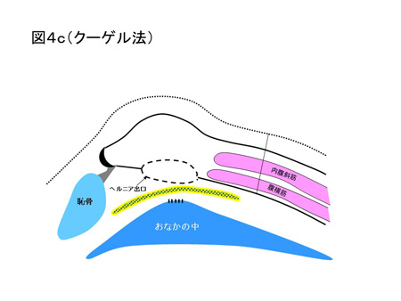 鼠径ヘルニア（成人）の手術方法について（図4c）