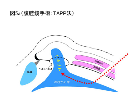 鼠径ヘルニア（成人）の手術方法について（図5a）