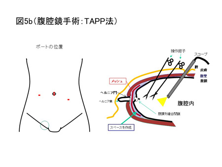 鼠径ヘルニア（成人）の手術方法について（図5b）