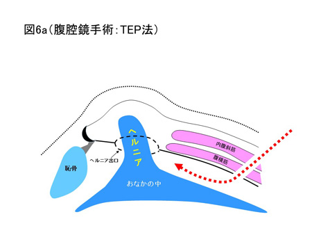 鼠径ヘルニア（成人）の手術方法について（図6a）