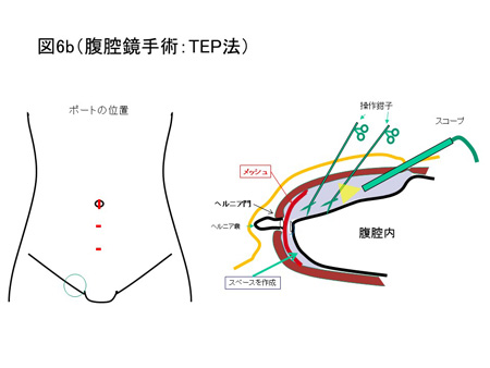 鼠径ヘルニア（成人）の手術方法について（図6b）