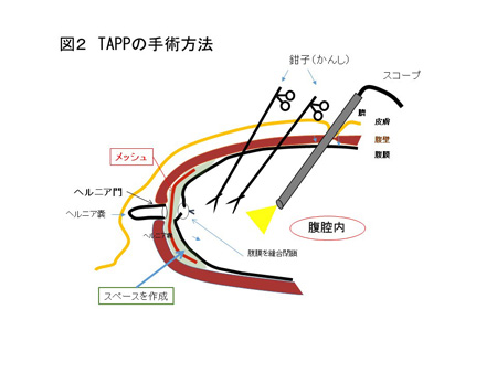 TAPP（図２）
