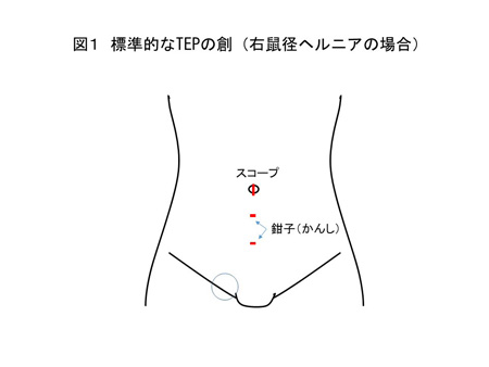 TEPについて（図１）