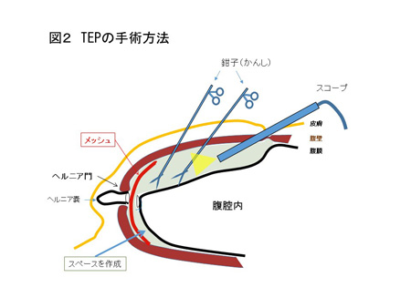 TEPについて（図２）